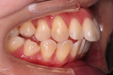 부산치아교정잘하는치과