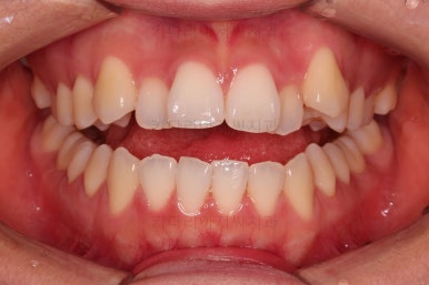 부산비발치교정