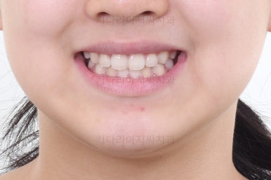 부산토끼치아교정