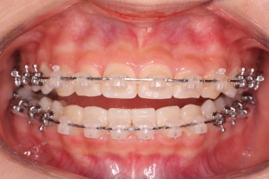 부산치아교정잘하는곳