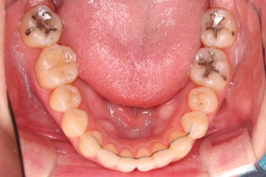 부산치아교정잘하는곳