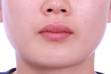 부산앞니부분교정