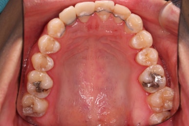 연산동치아교정