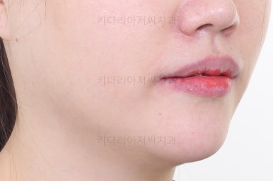 부산개방교합