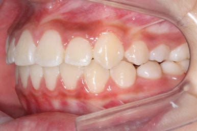 연산동덧니교정