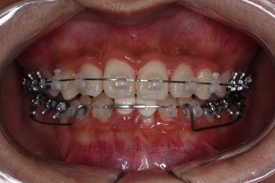 연산동치아교정