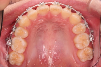 부산돌출입교정