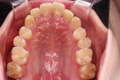 부산돌출입교정