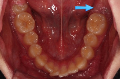 부산연산동사랑니발치