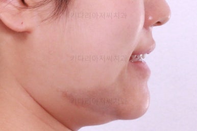 부산치아교정잘하는곳