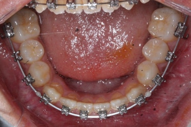 부산주걱턱교정