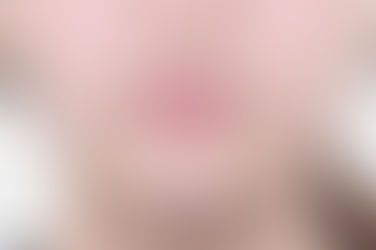 부산덧니교정