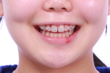 부산앞니벌어짐교정