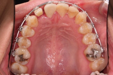 연산동치아교정