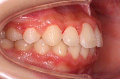 부산비발치교정