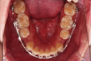 부산돌출입교정