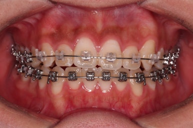 부산치아교정치과