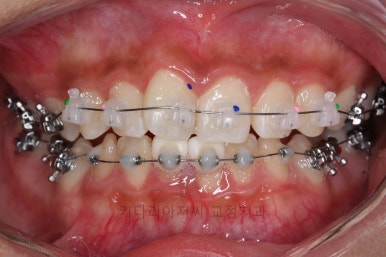 연산동치아교정