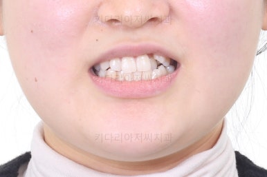 부산치아교정