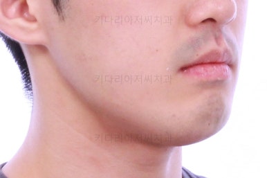 부산긴얼굴긴턱교정