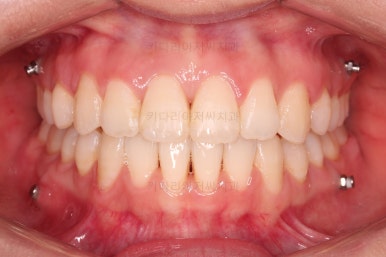 부산교정잘하는치과