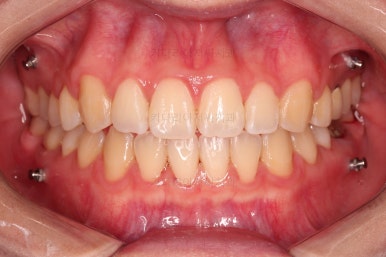 부산치아교정잘하는곳