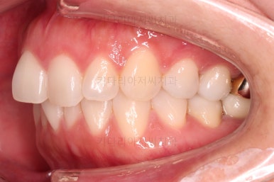 부산부분치아교정