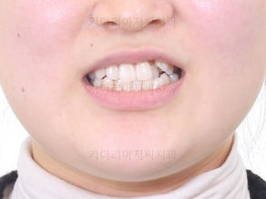 부산치아교정