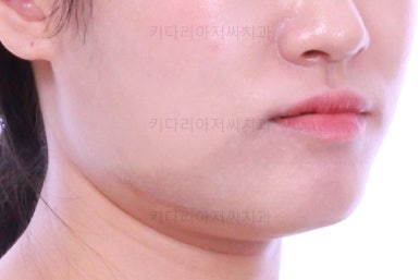 부산치아교정잘하는곳