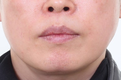 동래임플란트교정