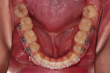 부산주걱턱교정