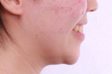 부산비발치교정