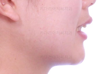 부산앞니부분교정