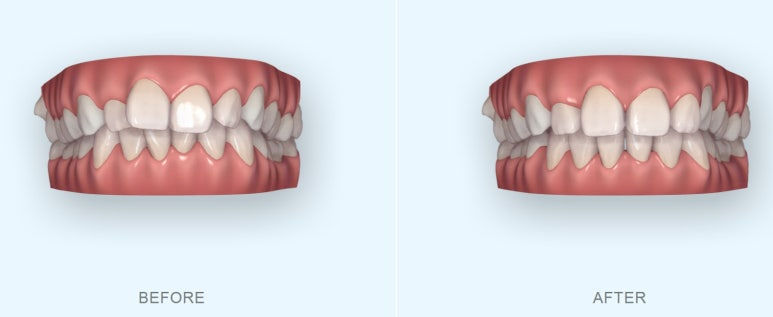 부산부분치아교정