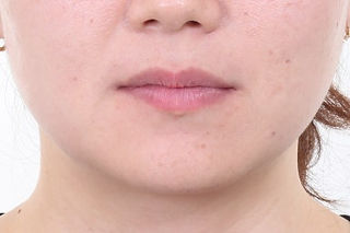 부산설측교정