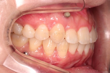 부산비대칭교정