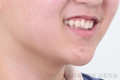 연산동치아교정