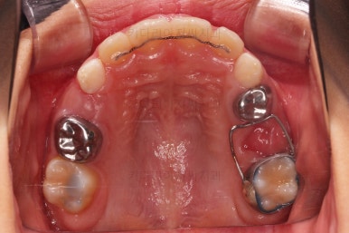 부산어린이반대교합