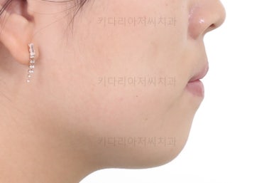 부산비발치교정