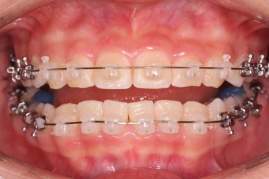 부산치아교정잘하는곳