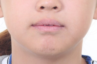 부산토끼치아교정