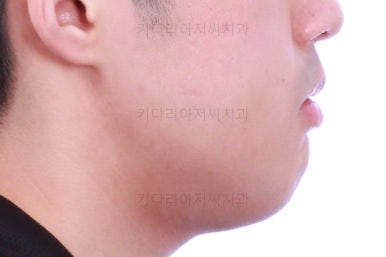 부산긴얼굴긴턱교정