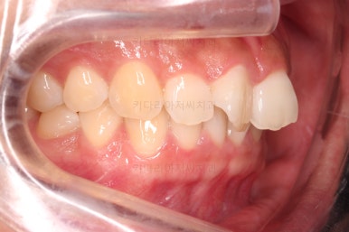 부산앞니부분교정