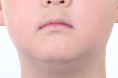 부산비발치교정