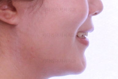 부산치아교정비용