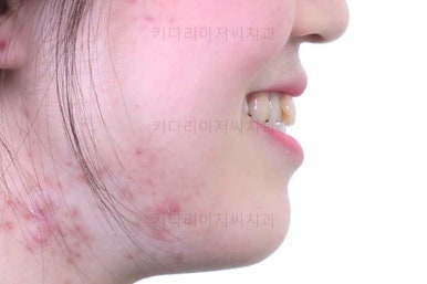 부산주걱턱교정