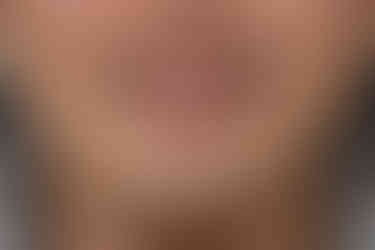 부산주걱턱교정