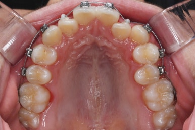 부산비발치교정