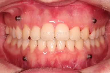 부산긴얼굴긴턱교정