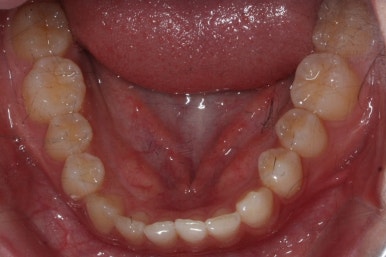부산매복치아교정